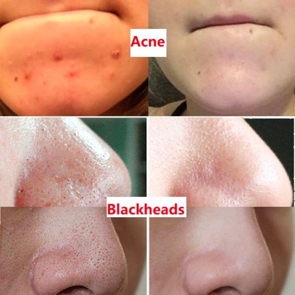 Deep Cleaning Detoxifying Facial Cleansing Clay MASK - Blackhead/oil remover - Picture 9 of 9